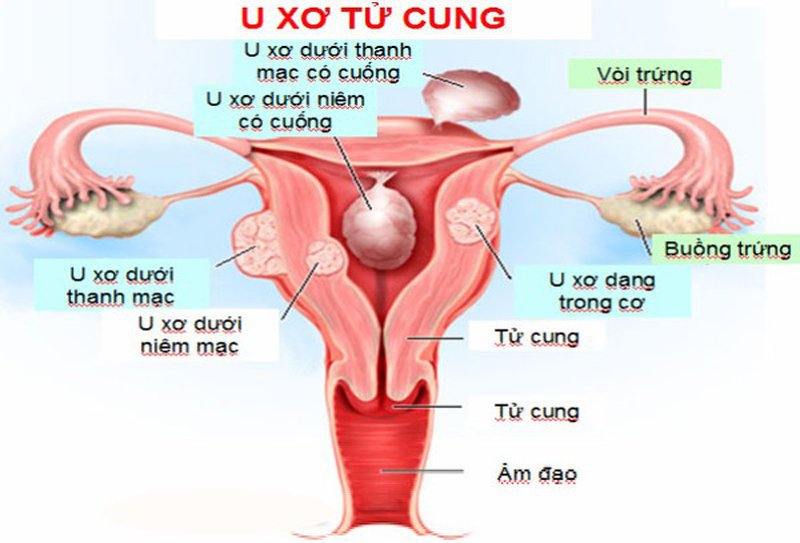 Nguyên nhân gây nên u xơ tử cung