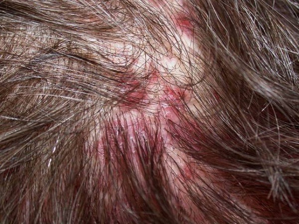 Viêm nang lông - nguyên nhân rụng tóc và ngứa da đầu
