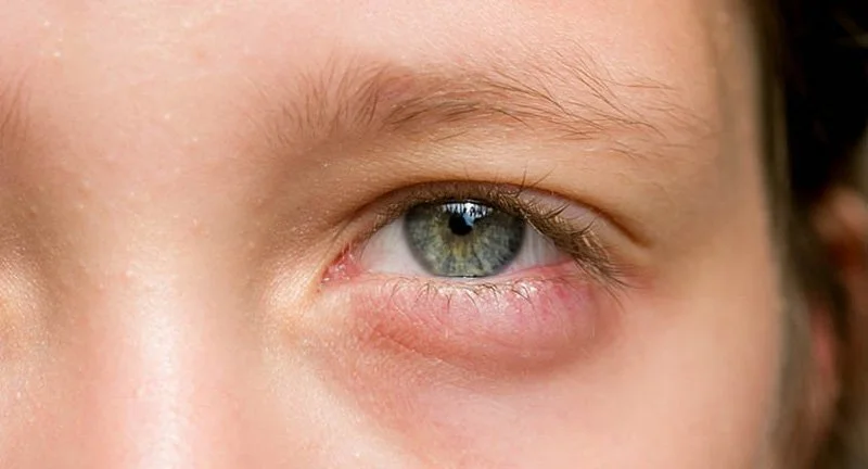 Bọng mắt - dấu hiệu lão hóa vùng da mắt