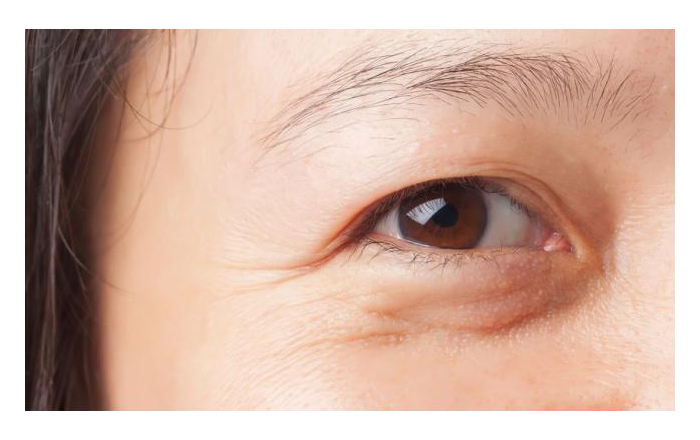 Nếp nhăn - dấu hiệu lão hóa vùng da mắt